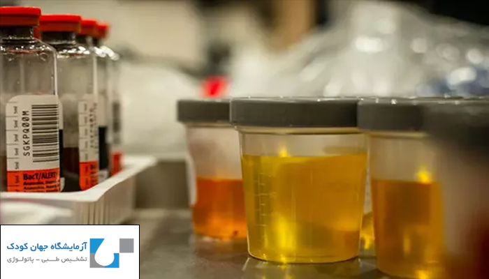 اهمیت آزمایش ادرار