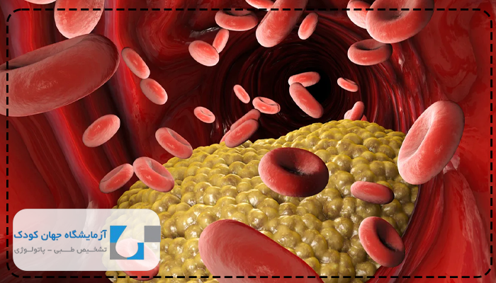 چربی خون در کودکان