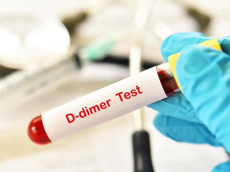 آزمایش D-dimer