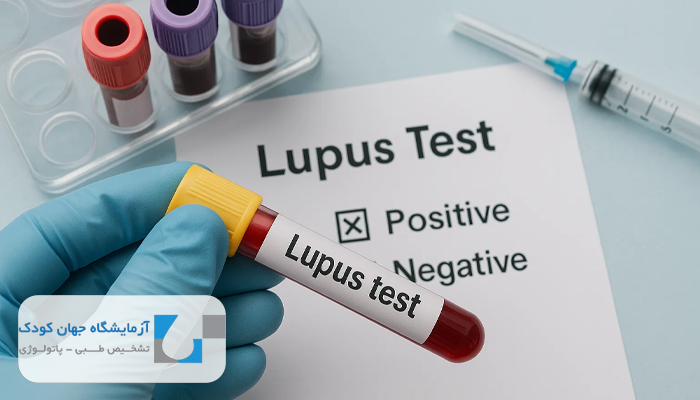 آزمایش لوپوس آنتی کواگولانت
