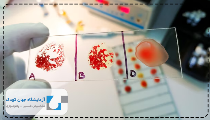 آزمایش لام خون محیطی برای چیست