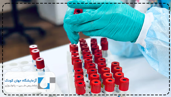 آزمایش کبد چرب در آزمایش خون