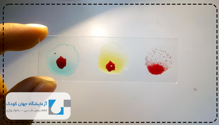 لام خون محیطی pbs