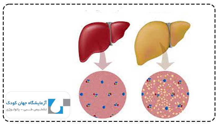 نرمال کبد چرب در آزمایش